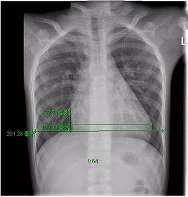 A Large Isolated Congenital Left Circumflex Artery-to-Right Atrial Fistula in a 9-Year-Old Child